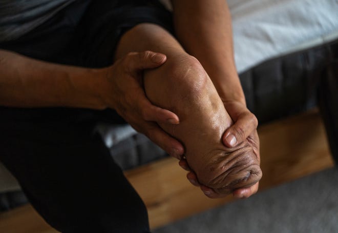 Jeff Wu, 47, of Lakeville, Minnesota rubs ointment on his leg while preparing to sleep following his third shift at a dairy factory on Wednesday, December 6, 2023. Wu had part of his leg amputated after being crushed severely when his 2014 Jeep Grand Cherokee rolled backward and struck him near a gas pump on March 4, 2022.
Wu said he had no idea about the danger and never received a recall notice from Chrysler to get the repair done.